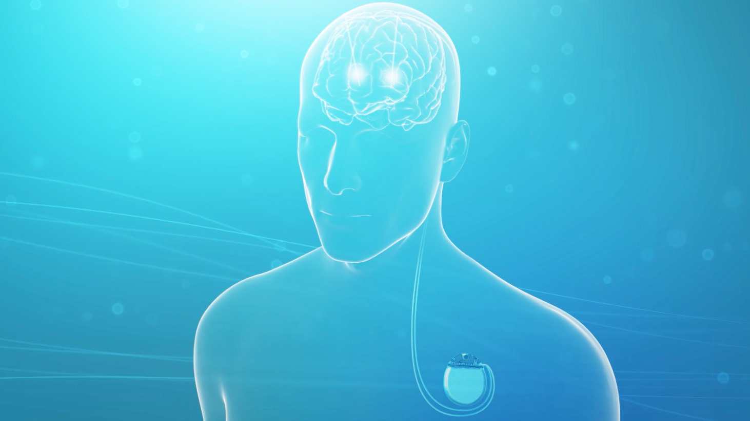 Vídeo sobre cómo funciona la terapia de Estimulación Cerebral Profunda
