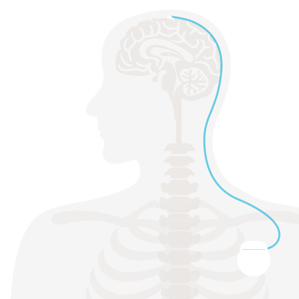 Illustration on the topic of deep brain stimulation (DBS): a torso and the connection between brain and brain pacemaker